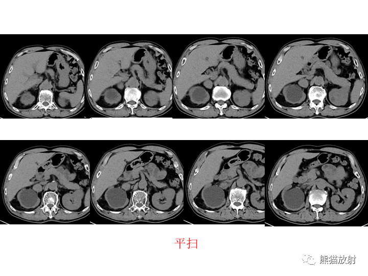 影像PPT - 【病例】腹膜后Castleman病2例CT及MR影像-4