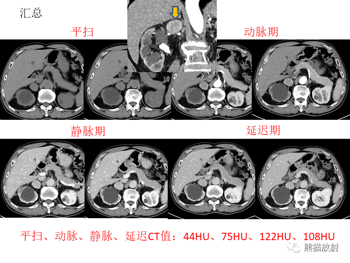 影像PPT - 【病例】腹膜后Castleman病2例CT及MR影像-9