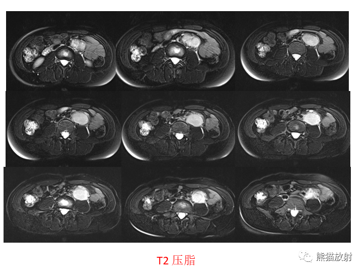 影像PPT - 【病例】腹膜后Castleman病2例CT及MR影像-12