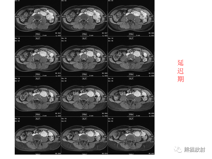 影像PPT - 【病例】腹膜后Castleman病2例CT及MR影像-16