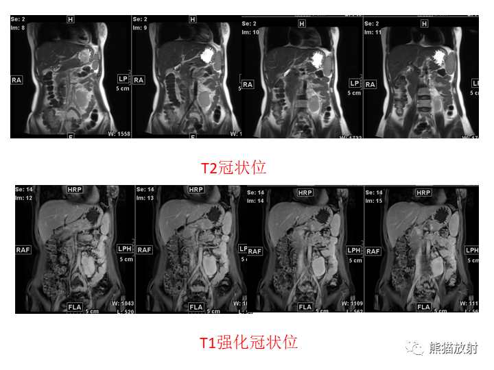 影像PPT - 【病例】腹膜后Castleman病2例CT及MR影像-19