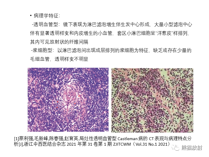 影像PPT - 【病例】腹膜后Castleman病2例CT及MR影像-25
