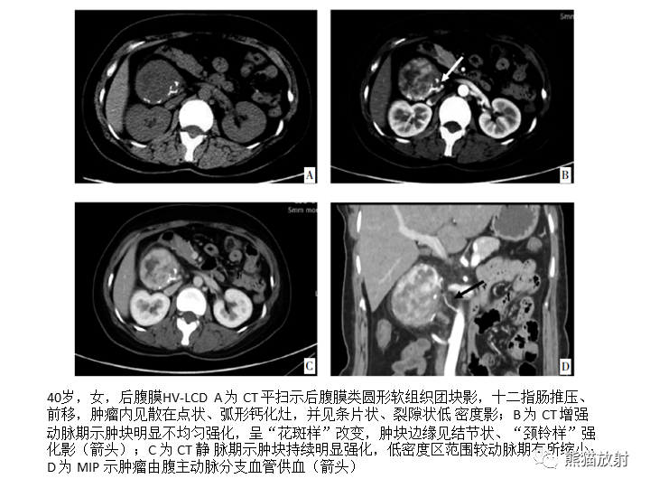 影像PPT - 【病例】腹膜后Castleman病2例CT及MR影像-30