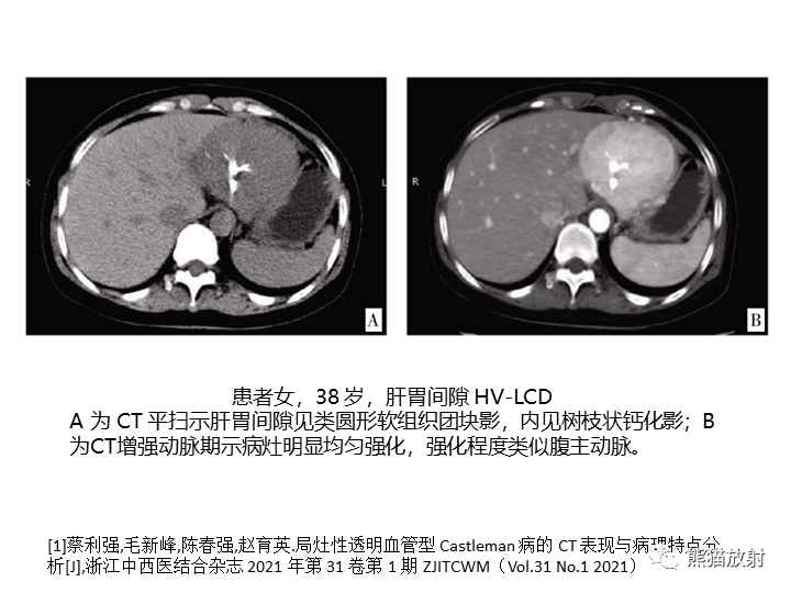 影像PPT - 【病例】腹膜后Castleman病2例CT及MR影像-29