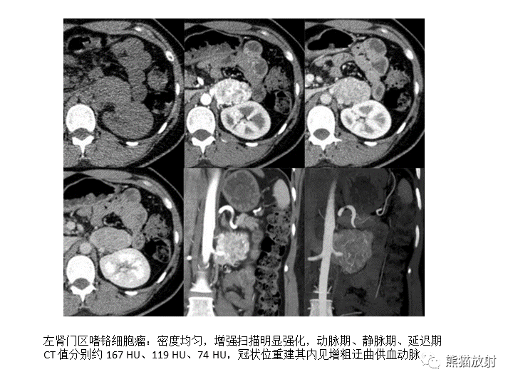 影像PPT - 【病例】腹膜后Castleman病2例CT及MR影像-33