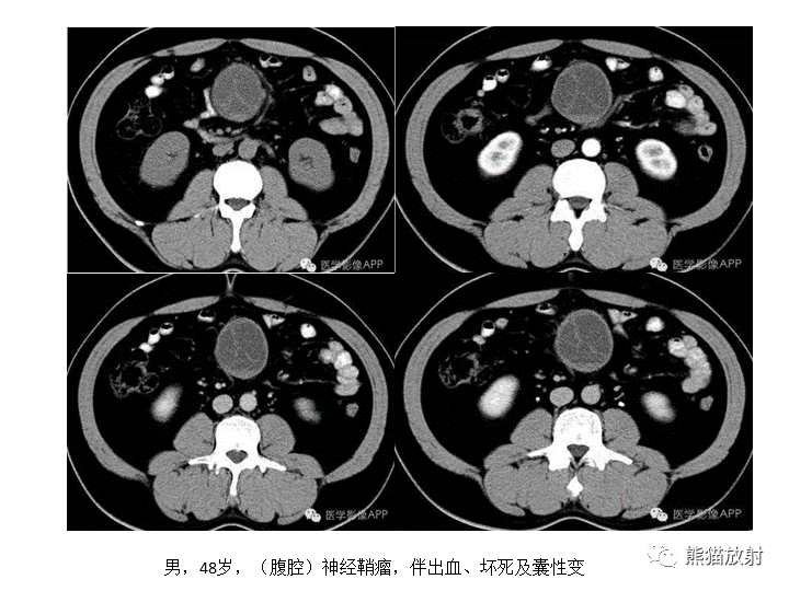 影像PPT - 【病例】腹膜后Castleman病2例CT及MR影像-35