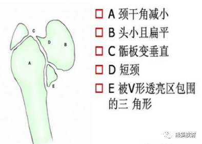 影像PPT - 骨与关节发育畸形(下肢)X线诊断要点-1 影像PPT - 骨与关节发育畸形(下肢)X线诊断要点-1