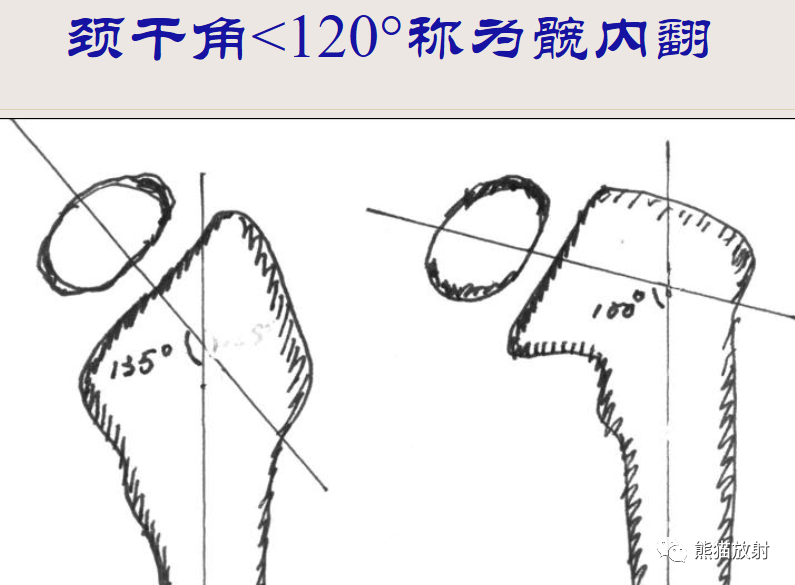 影像PPT - 骨与关节发育畸形(下肢)X线诊断要点-2 影像PPT - 骨与关节发育畸形(下肢)X线诊断要点-2