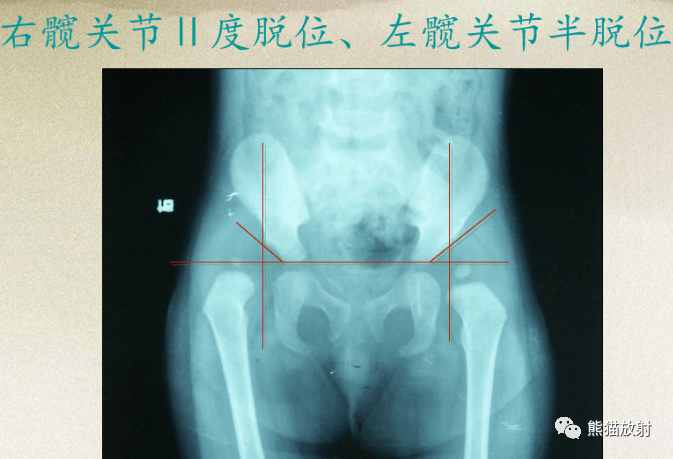 影像PPT - 骨与关节发育畸形(下肢)X线诊断要点-5 影像PPT - 骨与关节发育畸形(下肢)X线诊断要点-5
