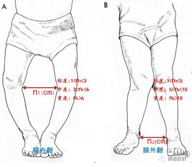 影像PPT - 骨与关节发育畸形(下肢)X线诊断要点-10 影像PPT - 骨与关节发育畸形(下肢)X线诊断要点-10