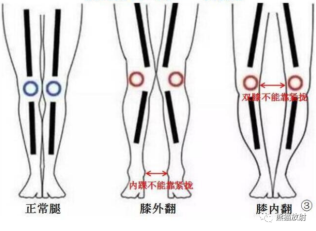 影像PPT - 骨与关节发育畸形(下肢)X线诊断要点-9 影像PPT - 骨与关节发育畸形(下肢)X线诊断要点-9