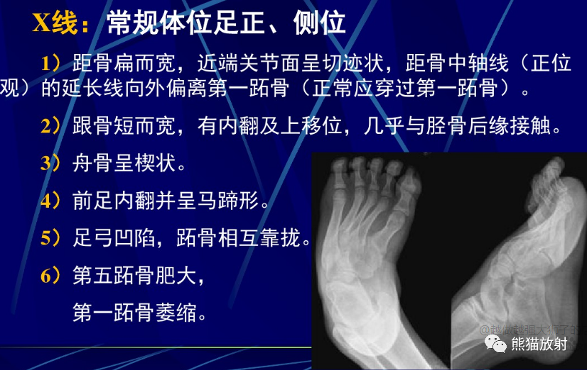 影像PPT - 骨与关节发育畸形(下肢)X线诊断要点-13 影像PPT - 骨与关节发育畸形(下肢)X线诊断要点-13