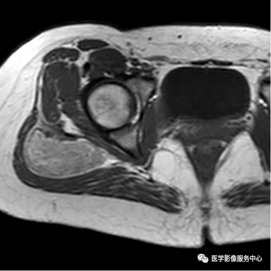 影像PPT - 【病例】冬眠瘤1例CT及MR影像-11 影像PPT - 【病例】冬眠瘤1例CT及MR影像-11