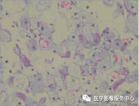 影像PPT - 【病例】冬眠瘤1例CT及MR影像-15 影像PPT - 【病例】冬眠瘤1例CT及MR影像-15