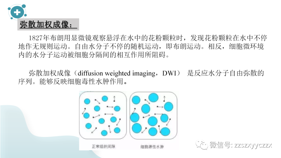 影像PPT - 【PPT】弥散加权成像阴性脑梗死-3