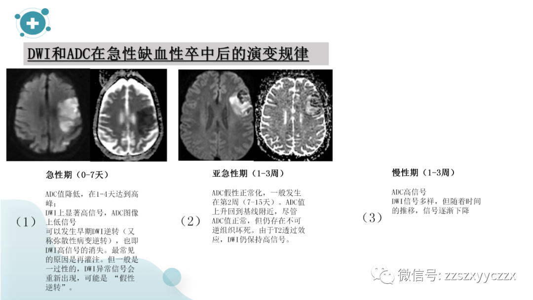 影像PPT - 【PPT】弥散加权成像阴性脑梗死-5