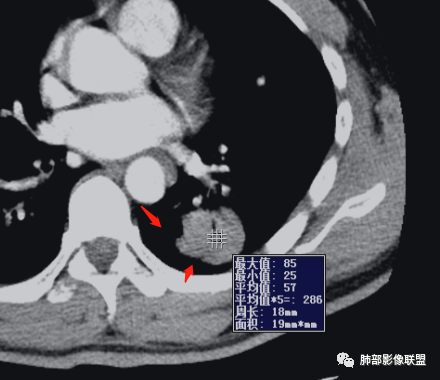 影像PPT - 【病例】 道貌岸然的肺腺癌-20 影像PPT - 【病例】 道貌岸然的肺腺癌-20