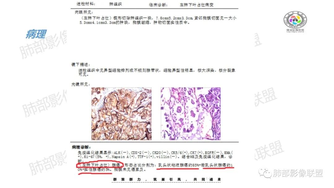 影像PPT - 【病例】 道貌岸然的肺腺癌-23 影像PPT - 【病例】 道貌岸然的肺腺癌-23