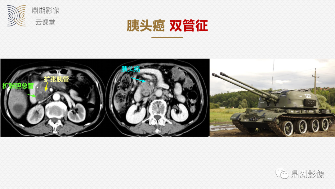 影像PPT - 速记!十五大影像特征与胰腺病变-1 影像PPT - 速记!十五大影像特征与胰腺病变-1