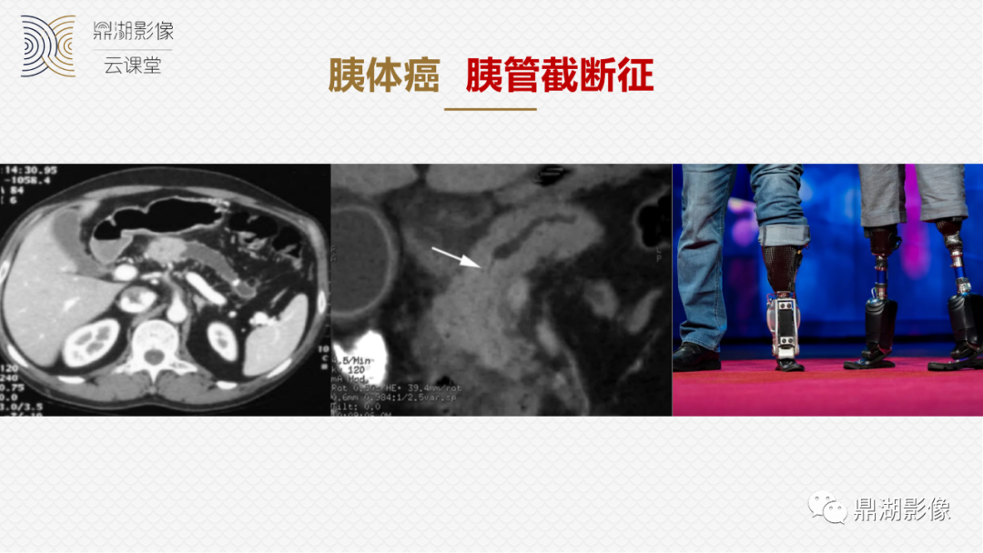 影像PPT - 速记!十五大影像特征与胰腺病变-2 影像PPT - 速记!十五大影像特征与胰腺病变-2