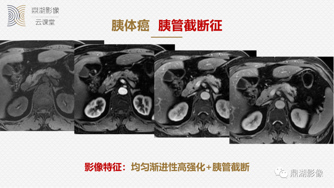 影像PPT - 速记!十五大影像特征与胰腺病变-3 影像PPT - 速记!十五大影像特征与胰腺病变-3