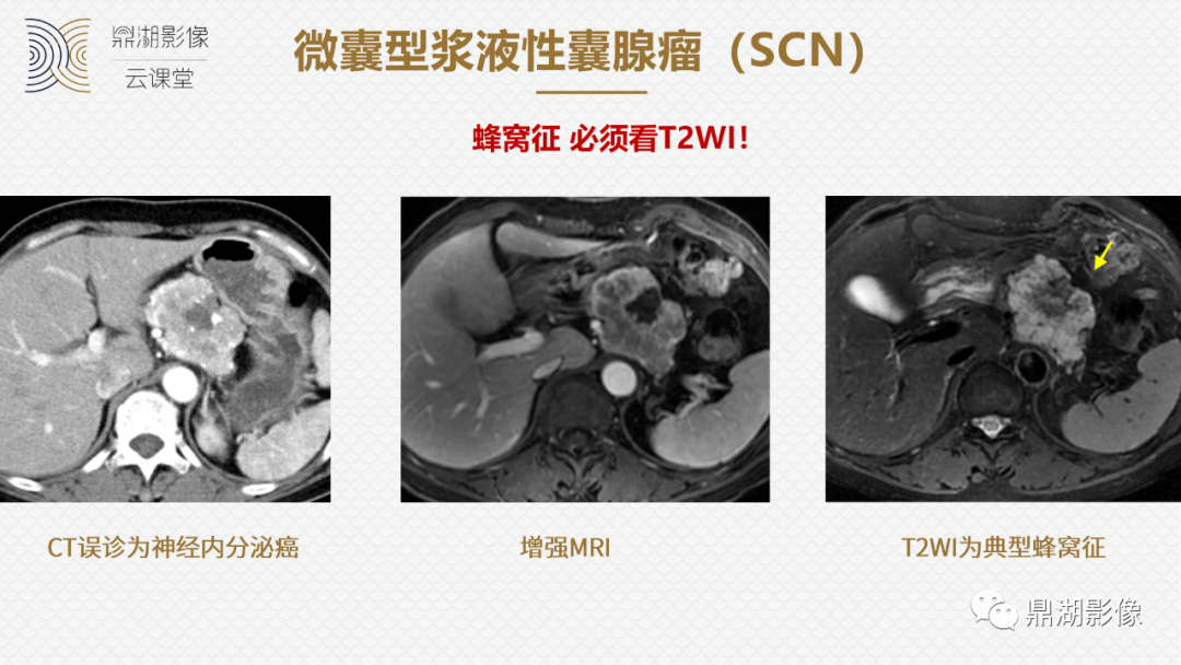 影像PPT - 速记!十五大影像特征与胰腺病变-5 影像PPT - 速记!十五大影像特征与胰腺病变-5