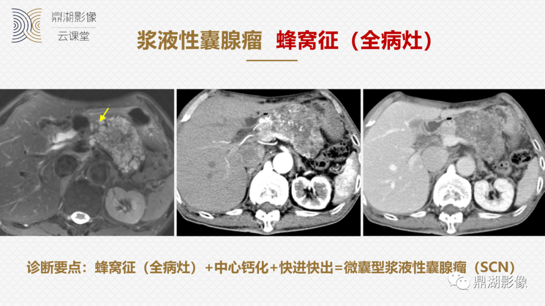 影像PPT - 速记!十五大影像特征与胰腺病变-4 影像PPT - 速记!十五大影像特征与胰腺病变-4
