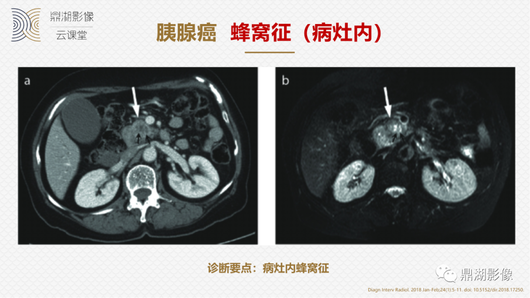 影像PPT - 速记!十五大影像特征与胰腺病变-6 影像PPT - 速记!十五大影像特征与胰腺病变-6