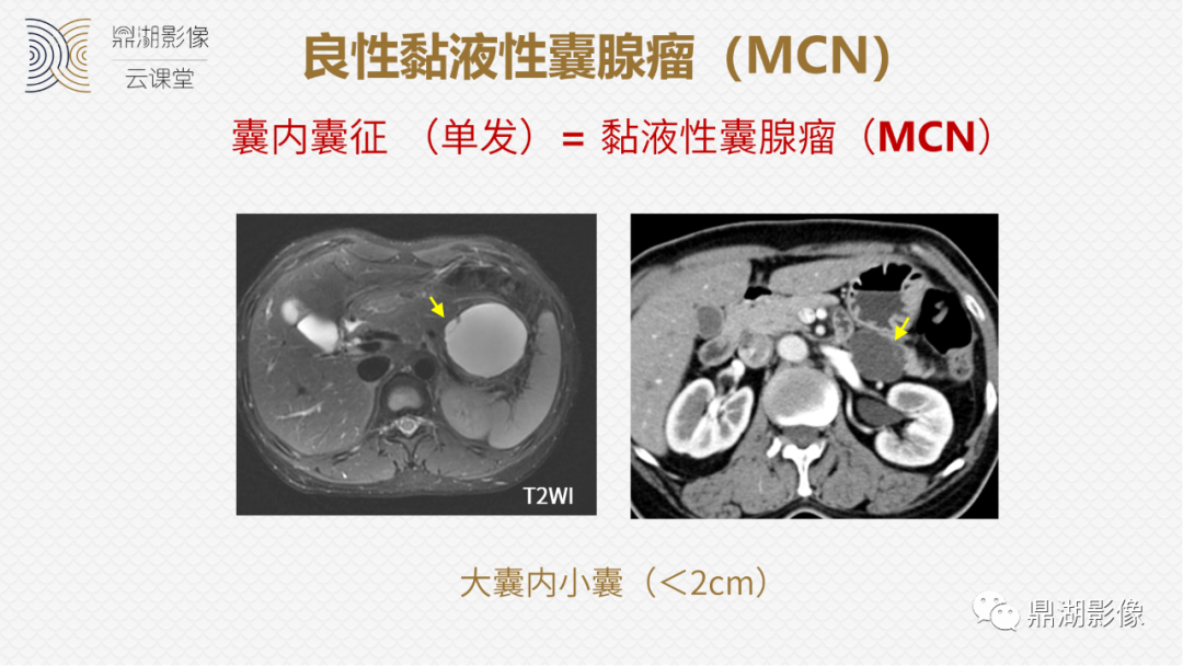 影像PPT - 速记!十五大影像特征与胰腺病变-11 影像PPT - 速记!十五大影像特征与胰腺病变-11