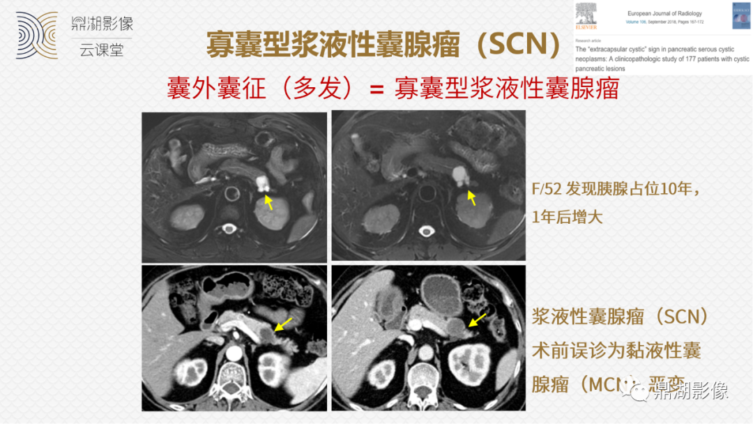 影像PPT - 速记!十五大影像特征与胰腺病变-8 影像PPT - 速记!十五大影像特征与胰腺病变-8
