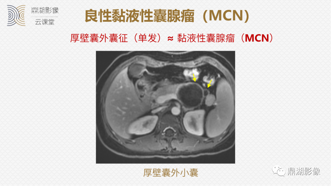 影像PPT - 速记!十五大影像特征与胰腺病变-10 影像PPT - 速记!十五大影像特征与胰腺病变-10