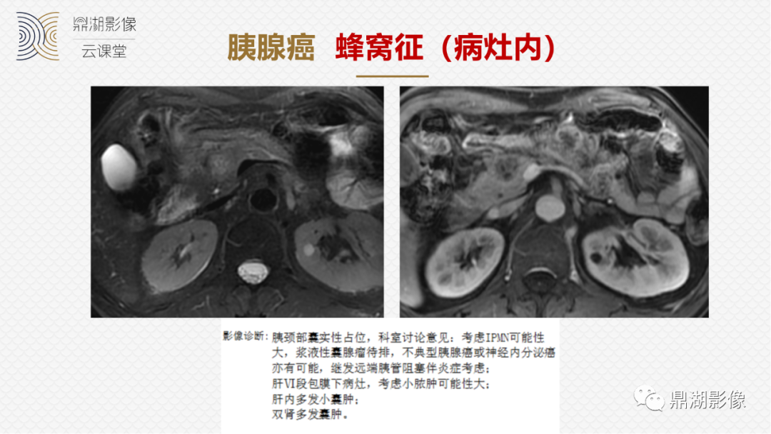 影像PPT - 速记!十五大影像特征与胰腺病变-7 影像PPT - 速记!十五大影像特征与胰腺病变-7