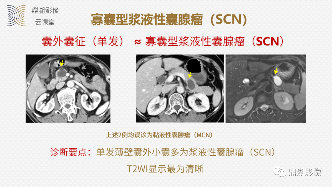 影像PPT - 速记!十五大影像特征与胰腺病变-9 影像PPT - 速记!十五大影像特征与胰腺病变-9