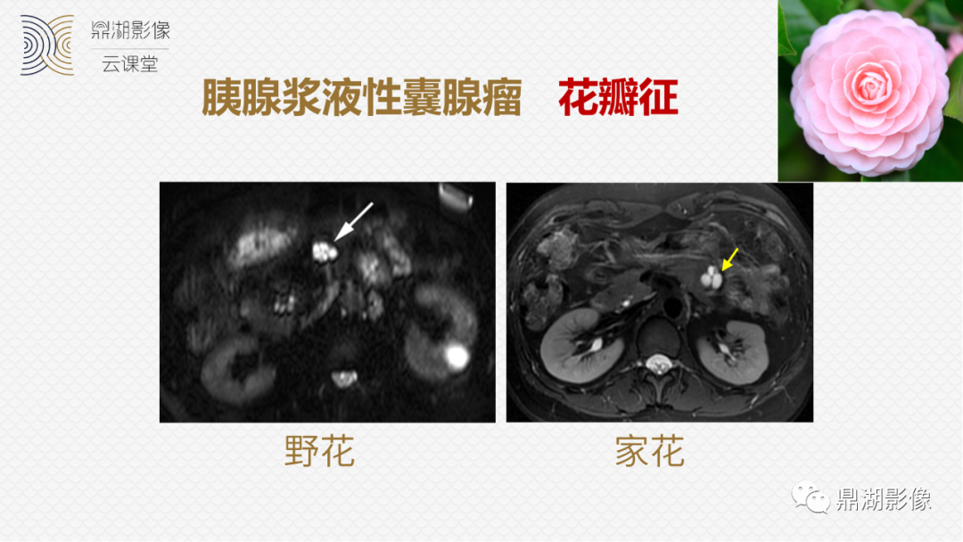 影像PPT - 速记!十五大影像特征与胰腺病变-12 影像PPT - 速记!十五大影像特征与胰腺病变-12