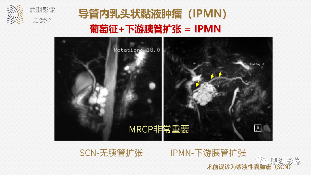 影像PPT - 速记!十五大影像特征与胰腺病变-14 影像PPT - 速记!十五大影像特征与胰腺病变-14