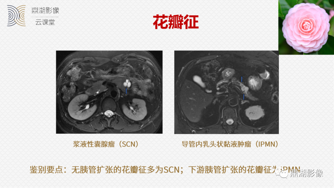 影像PPT - 速记!十五大影像特征与胰腺病变-13 影像PPT - 速记!十五大影像特征与胰腺病变-13