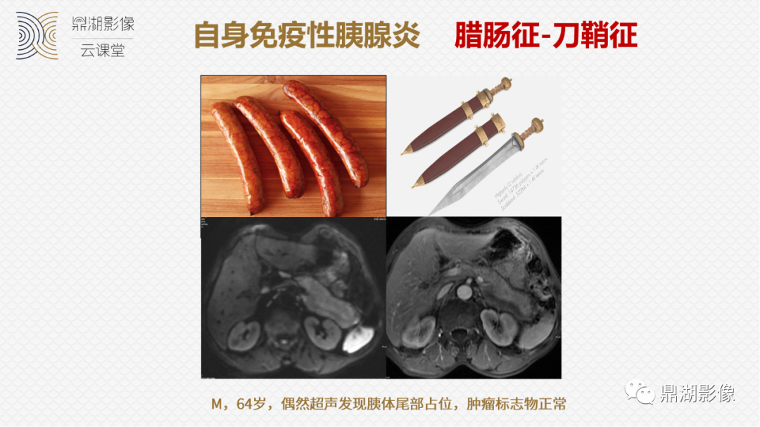 影像PPT - 速记!十五大影像特征与胰腺病变-15 影像PPT - 速记!十五大影像特征与胰腺病变-15