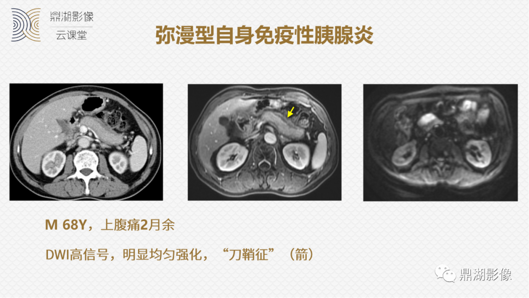 影像PPT - 速记!十五大影像特征与胰腺病变-16 影像PPT - 速记!十五大影像特征与胰腺病变-16