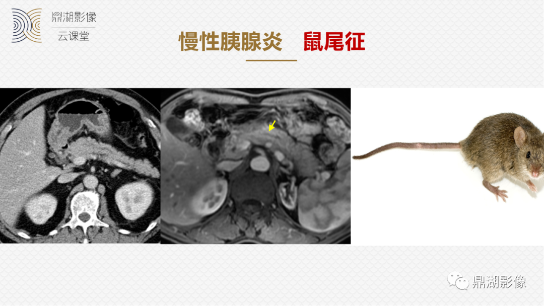 影像PPT - 速记!十五大影像特征与胰腺病变-17 影像PPT - 速记!十五大影像特征与胰腺病变-17