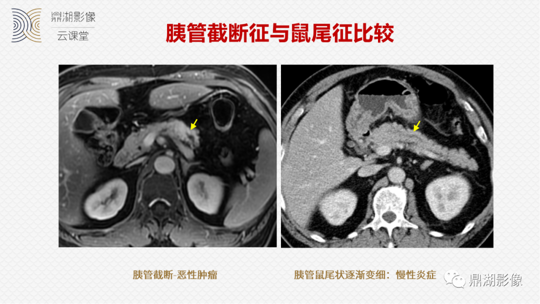 影像PPT - 速记!十五大影像特征与胰腺病变-18 影像PPT - 速记!十五大影像特征与胰腺病变-18