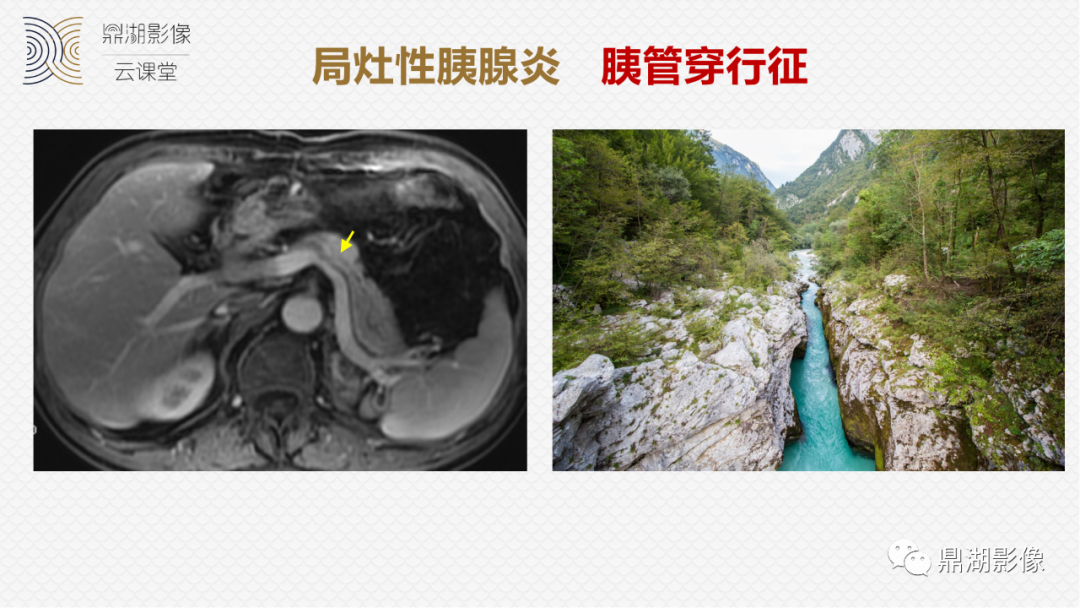 影像PPT - 速记!十五大影像特征与胰腺病变-19 影像PPT - 速记!十五大影像特征与胰腺病变-19