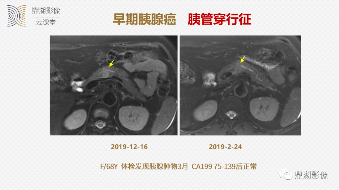 影像PPT - 速记!十五大影像特征与胰腺病变-21 影像PPT - 速记!十五大影像特征与胰腺病变-21