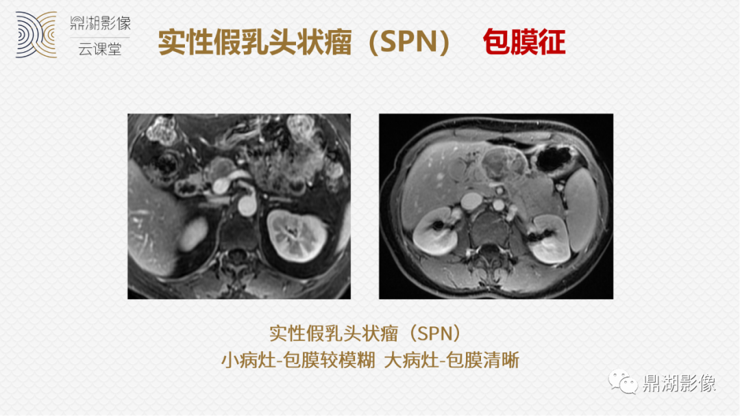 影像PPT - 速记!十五大影像特征与胰腺病变-23 影像PPT - 速记!十五大影像特征与胰腺病变-23