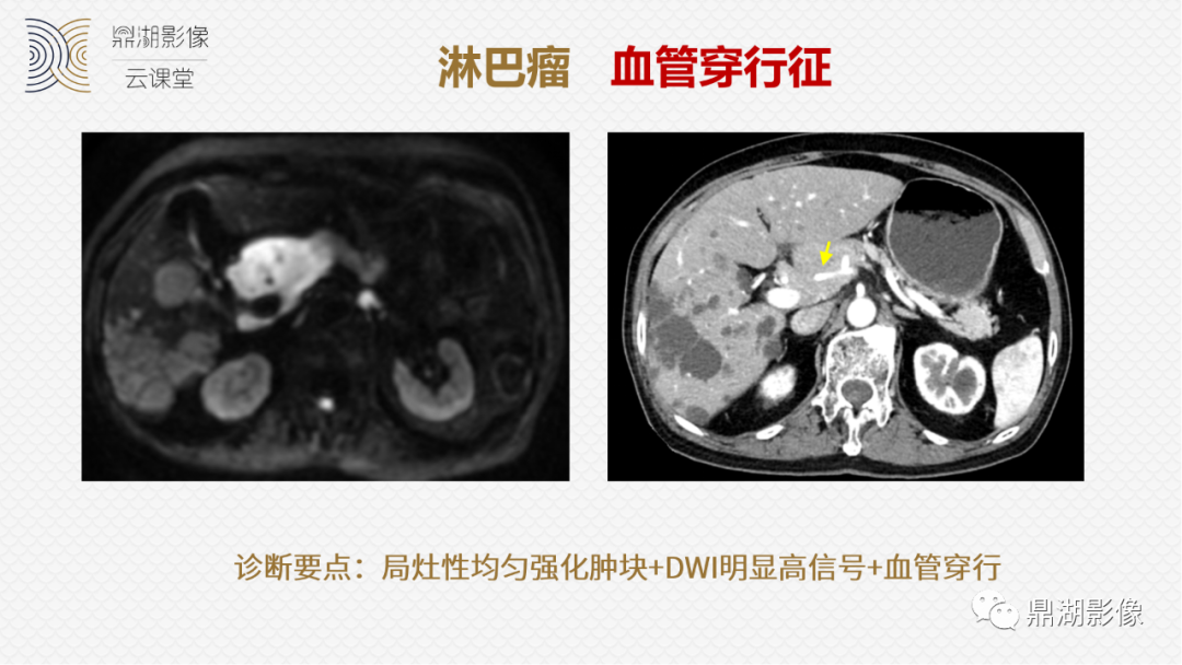 影像PPT - 速记!十五大影像特征与胰腺病变-22 影像PPT - 速记!十五大影像特征与胰腺病变-22