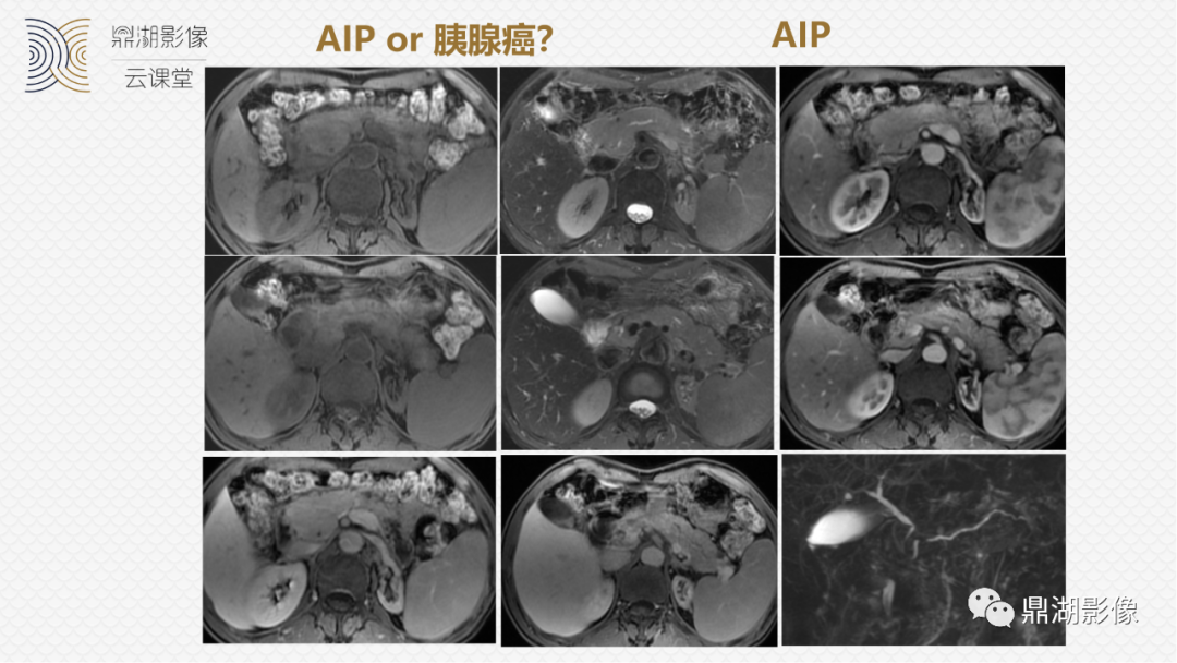 影像PPT - 速记!十五大影像特征与胰腺病变-20 影像PPT - 速记!十五大影像特征与胰腺病变-20