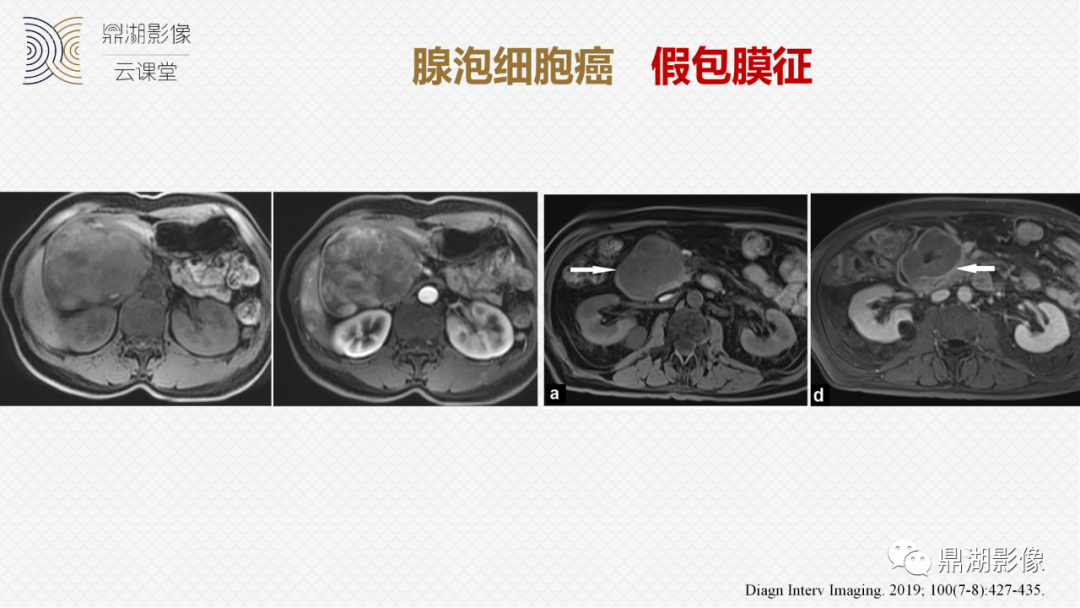 影像PPT - 速记!十五大影像特征与胰腺病变-24 影像PPT - 速记!十五大影像特征与胰腺病变-24