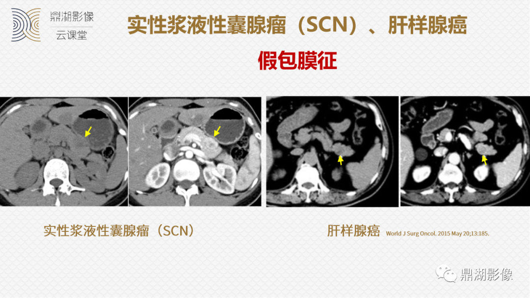 影像PPT - 速记!十五大影像特征与胰腺病变-25 影像PPT - 速记!十五大影像特征与胰腺病变-25