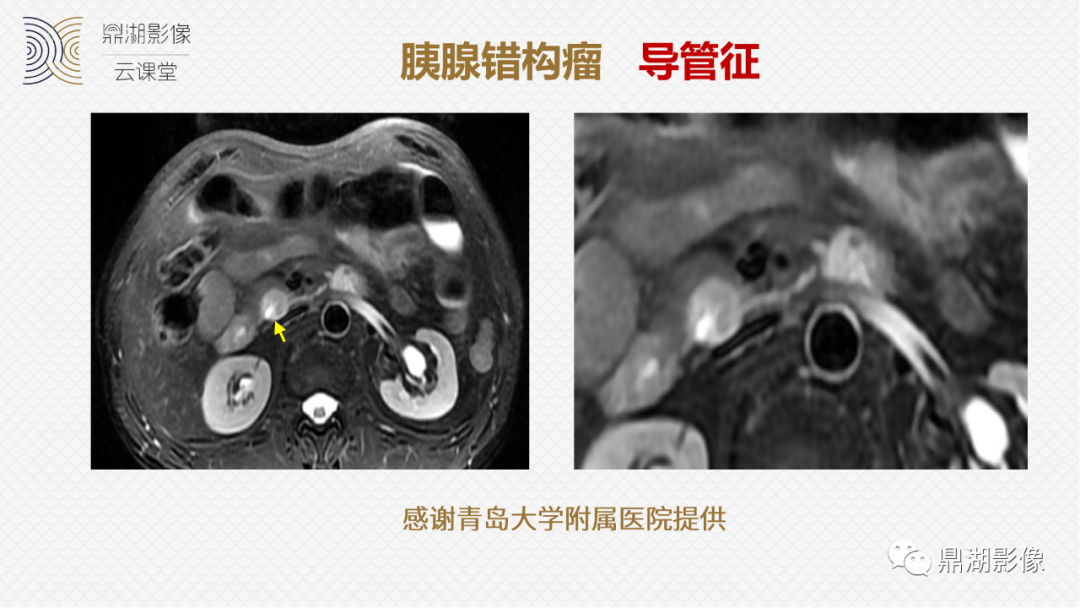 影像PPT - 速记!十五大影像特征与胰腺病变-26 影像PPT - 速记!十五大影像特征与胰腺病变-26