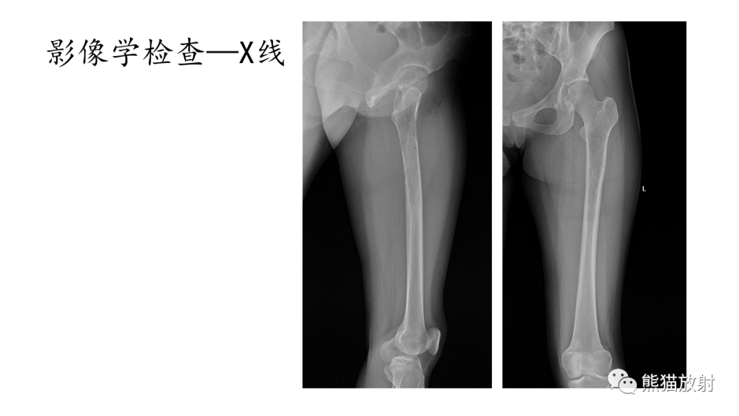 影像PPT - 【病例】股骨纤维肉瘤 VS 胸骨浆细胞瘤-3