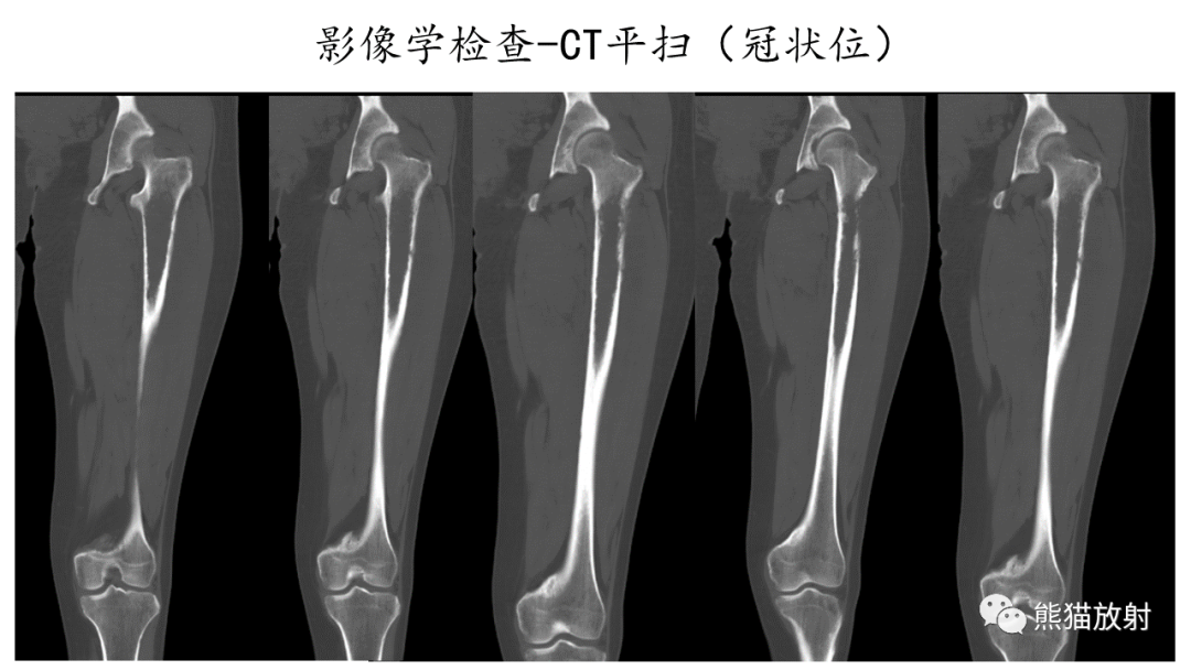 影像PPT - 【病例】股骨纤维肉瘤 VS 胸骨浆细胞瘤-6